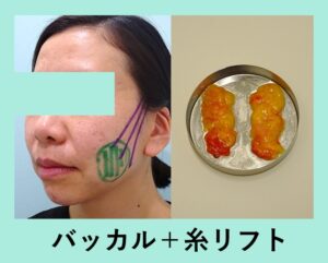 『顔の重心を変える「小顔組み合わせ治療」』の画像