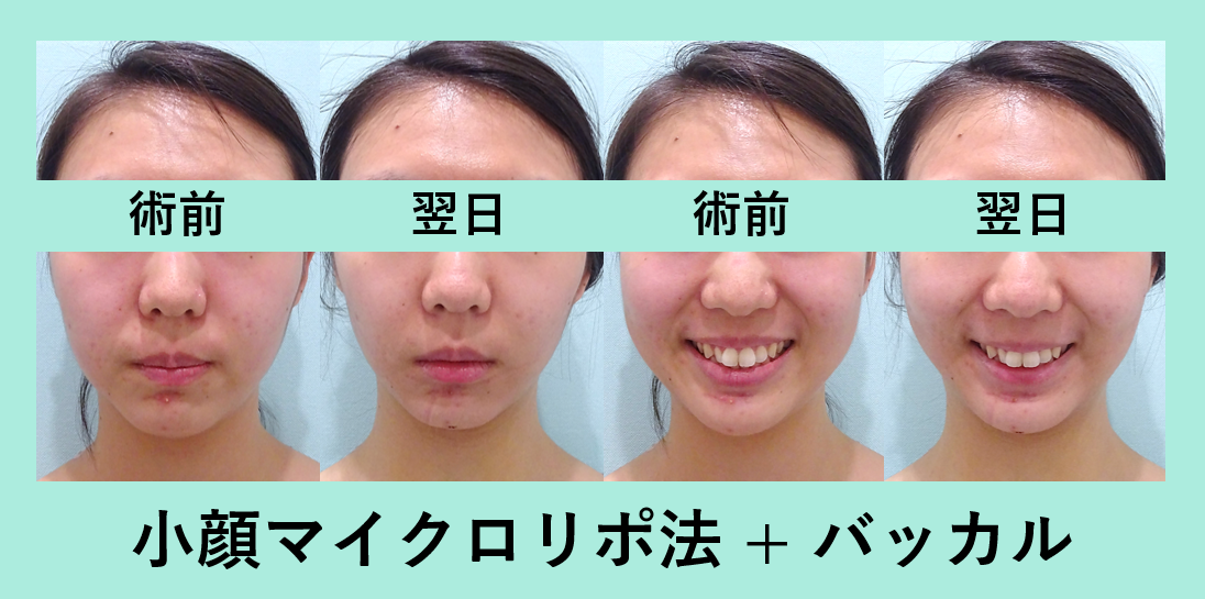 最小ダウンタイム 頬こけなし 小顔組み合わせ治療 東京 銀座の美容外科クリニックwom Clinic Ginza