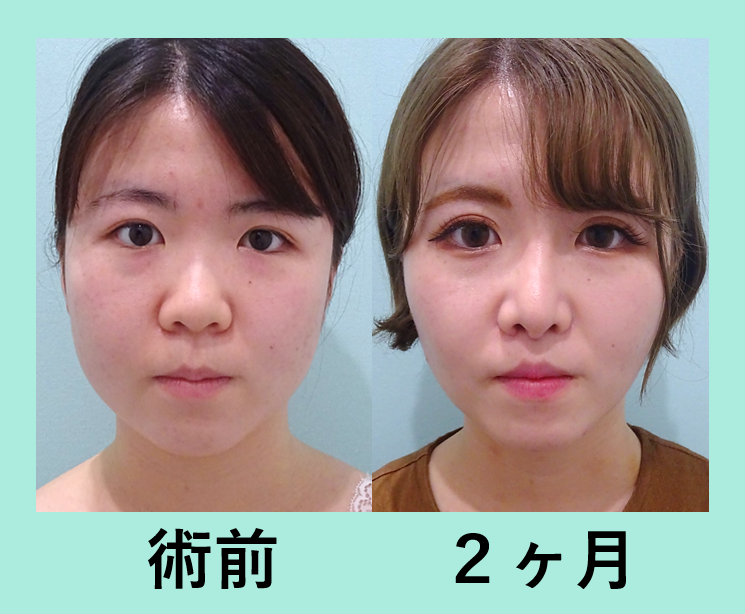 がらりと印象が変わる 全顔整形 東京 銀座の美容外科クリニックwom Clinic Ginza
