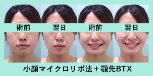 『顔のバランスを整える「小顔マイクロリポ法」』の画像