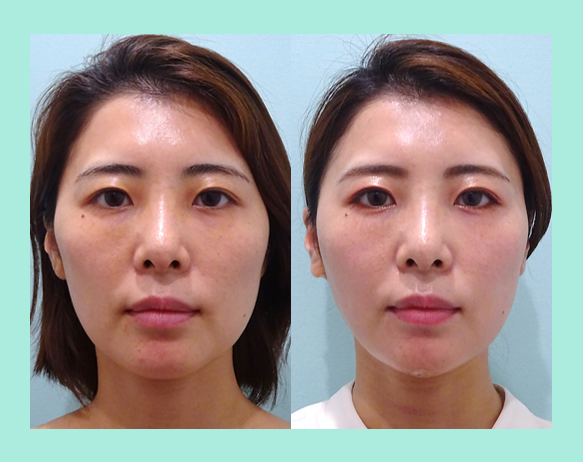 頬こけ脂肪注入 東京 銀座の美容外科クリニックwom Clinic Ginza