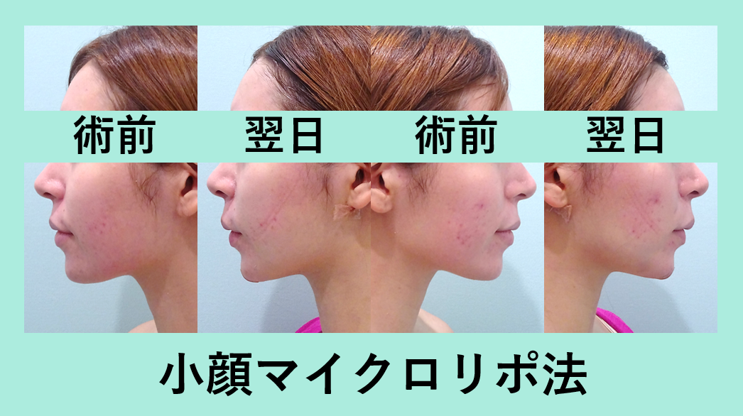 小顔 脂肪吸引 ダウンタイム