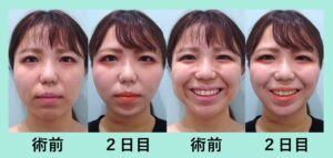 『横顔が激的変化！「小顔組み合わせ治療」』の画像