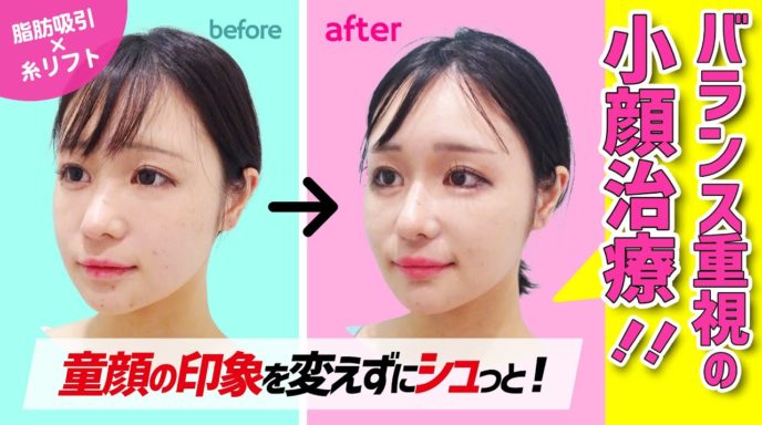 頬と顎下の脂肪吸引 東京 銀座の美容外科クリニックwom Clinic Ginza Part 2 頬と顎下の脂肪吸引 東京 銀座の美容外科クリニックwom Clinic Ginza Part 2
