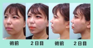 『横顔が激的変化！「小顔組み合わせ治療」』の画像