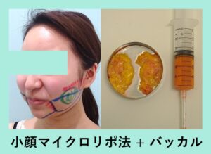 『丸顔から卒業！「小顔組み合わせ治療」』の画像