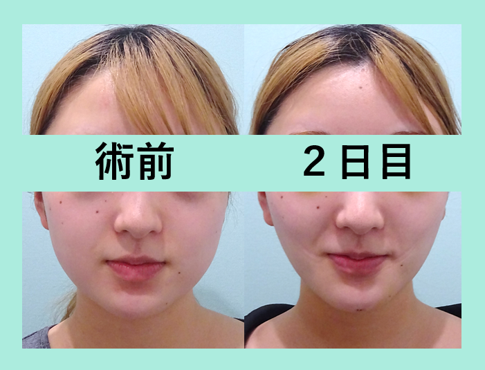 小顔 脂肪吸引 ビフォーアフター
