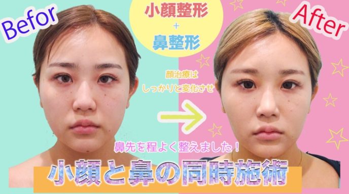 ビフォー アフター 整形 鼻