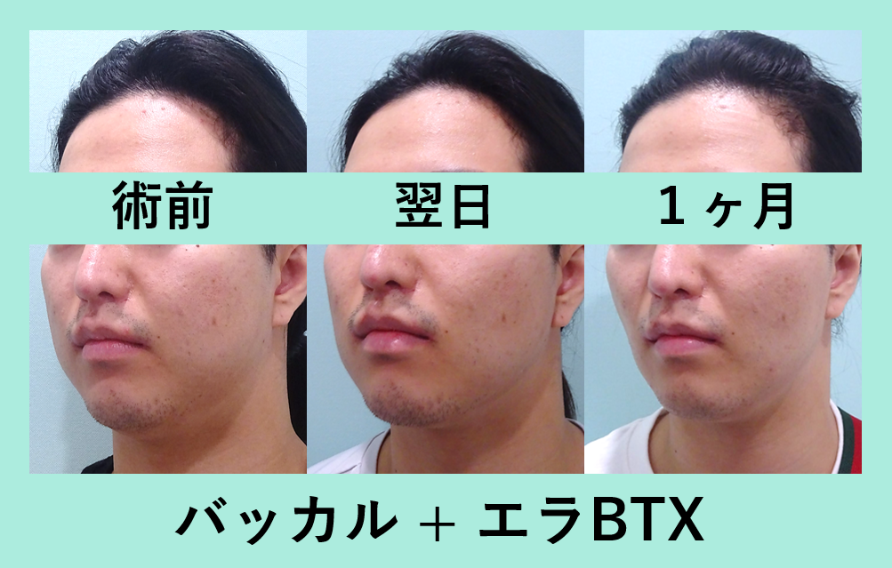 男性の施術が増えています バッカルファット術 東京 銀座の美容外科クリニックwom Clinic Ginza