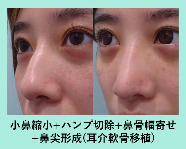 小さく可愛い鼻にしたい 東京 銀座の美容外科クリニックwom Clinic Ginza