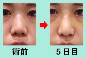 『こだわりの技術で「バランスの取れた端整な鼻」を最小ダウンタイムで実現！』の画像