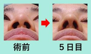 『こだわりの技術で「バランスの取れた端整な鼻」を最小ダウンタイムで実現！』の画像
