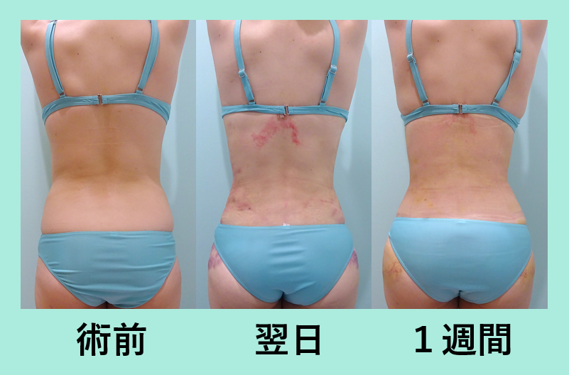 芸術的にがっつり取ります しかもダウンタイム最小です 背中と腰の脂肪吸引 東京 銀座の美容外科クリニックwom Clinic Ginza