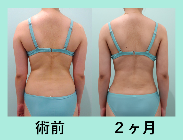 二の腕 肩 腰 付け根 脂肪吸引 ダウンタイム