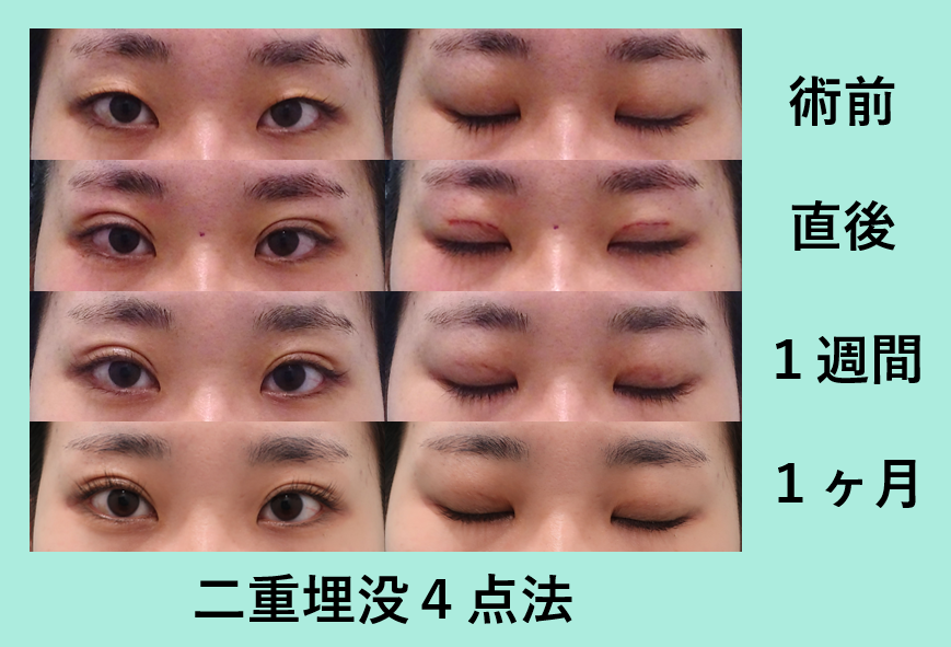 二重埋没法 ダウンタイム