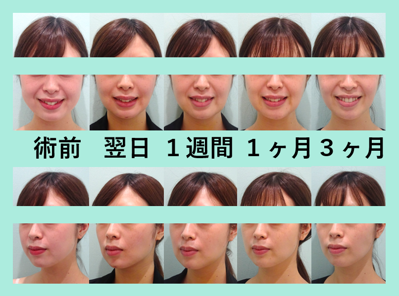 幼い丸顔 大人っぽい輪郭に 小顔組み合わせ治療 東京 銀座の美容外科クリニックwom Clinic Ginza