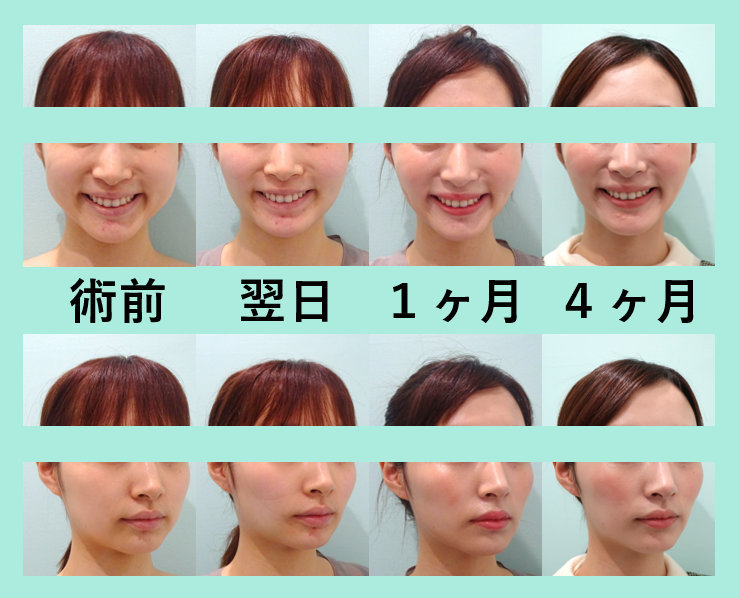 吸引少なめ バッカル多めのパターン 小顔組み合わせ治療 東京 銀座の美容外科クリニックwom Clinic Ginza