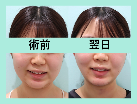 小顔 脂肪吸引 ビフォーアフター