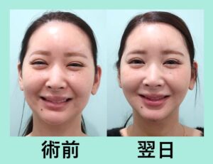 『３人分まとめて施術翌日の経過をご紹介します！「小顔組み合わせ治療」』の画像