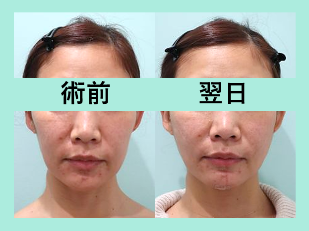 頬こけ脂肪注入 東京 銀座の美容外科クリニックwom Clinic Ginza