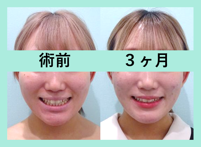 小顔　脂肪吸引　 ビフォーアフター