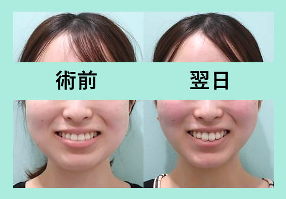 小顔　脂肪吸引　 ビフォーアフター