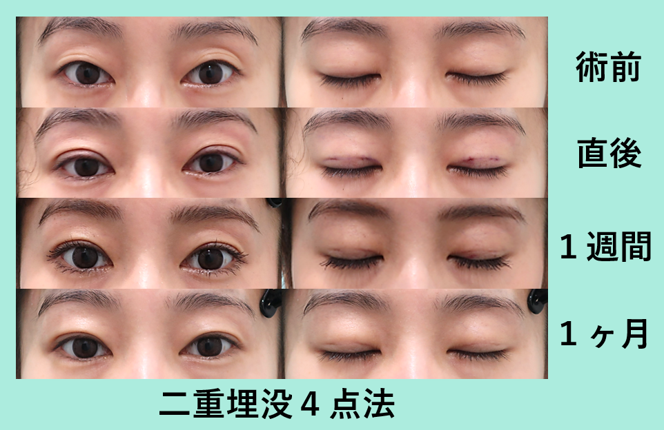 二重埋没法 ダウンタイム