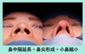 『施術直後の形「鼻の複合施術」』の画像
