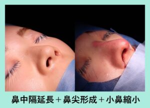 『施術直後の形「鼻の複合施術」』の画像