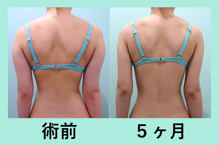 脂肪吸引 ダウンタイム