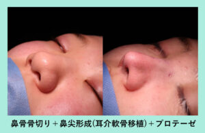 『「大きな鼻」を、基本の手術でしっかり小さくします！』の画像