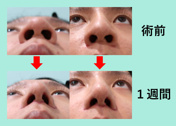大きな鼻 を小さくしたい 東京 銀座の美容外科クリニックwom Clinic Ginza