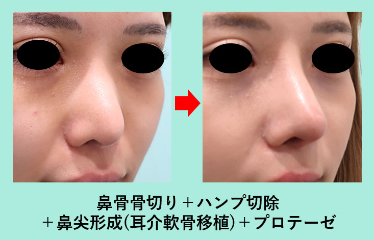 高難度 他院の鼻術後の修正 骨切り幅寄せの複合手術 東京 銀座の美容外科クリニックwom Clinic Ginza