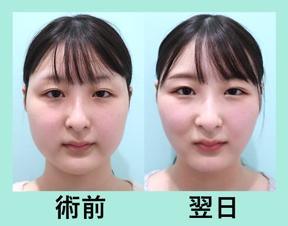 顎先ボトックス 東京 銀座の美容外科クリニックwom Clinic Ginza Part 2