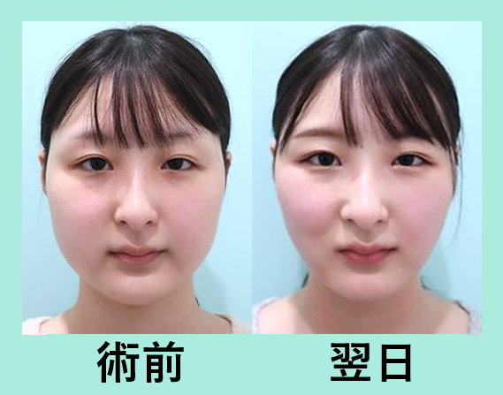 顎先ボトックス 東京 銀座の美容外科クリニックwom Clinic Ginza Part 2 顎先ボトックス 東京 銀座の美容外科クリニックwom Clinic Ginza Part 2