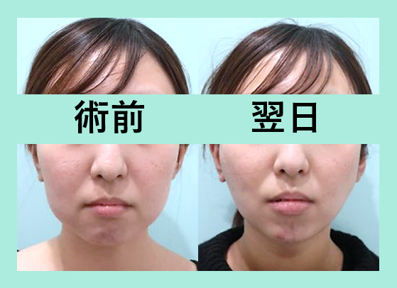 頬こけ脂肪注入 東京 銀座の美容外科クリニックwom Clinic Ginza 頬こけ脂肪注入 東京 銀座の美容外科クリニックwom Clinic Ginza