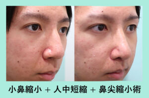 大きな鼻 を小さくしたい 東京 銀座の美容外科クリニックwom Clinic Ginza 大きな鼻 を小さくしたい 東京 銀座の美容外科クリニックwom Clinic Ginza