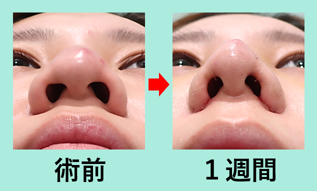 大きなニンニク鼻を なるべく自然な感じで小さくしたい 東京 銀座の美容外科クリニックwom Clinic Ginza