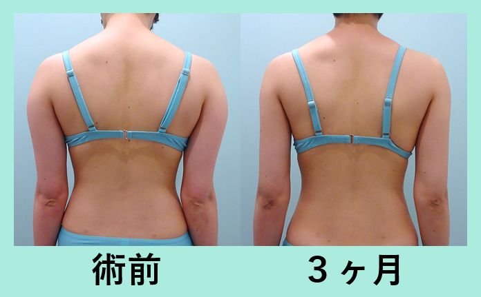 二の腕肩付け根脂肪吸引_術後3ヶ月、全身脂肪吸引