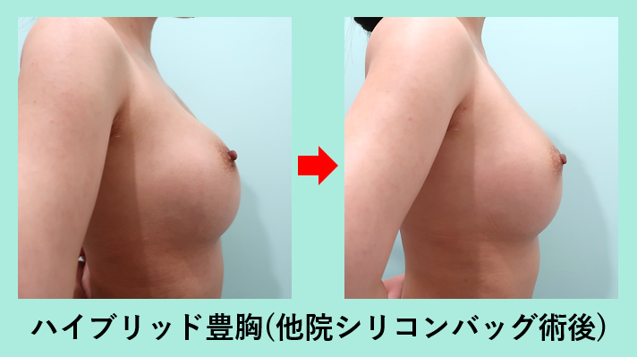ハイブリッド脂肪豊胸 シリコンバッグ 不自然