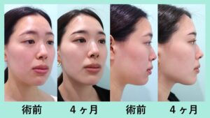 『超高難易度テクニックで顔の左右差を改善！？ WOMでしか受けられない顔の脂肪同時移植「小顔組み合わせ治療」』の画像