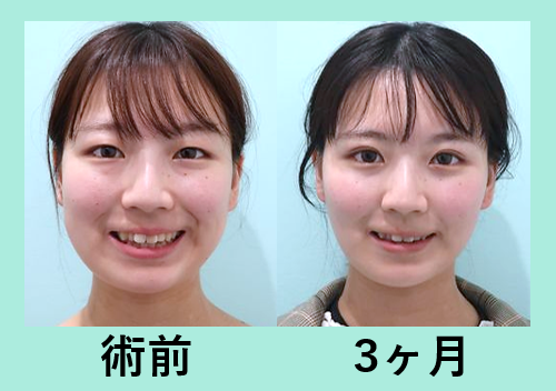 ほほ あご下吸引 東京 銀座の美容外科クリニックwom Clinic Ginza Part 5 ほほ あご下吸引 東京 銀座の美容外科クリニックwom Clinic Ginza Part 5