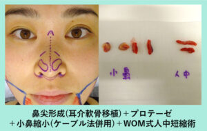 『鼻尖と小鼻、小顔治療の手術を、すべて一日で可能に！』の画像