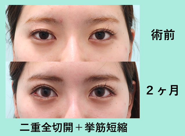 目尻切開 東京 銀座の美容外科クリニックwom Clinic Ginza 目尻切開 東京 銀座の美容外科クリニックwom Clinic Ginza