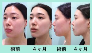 『超高難易度テクニックで顔の左右差を改善！？ WOMでしか受けられない顔の脂肪同時移植「小顔組み合わせ治療」』の画像