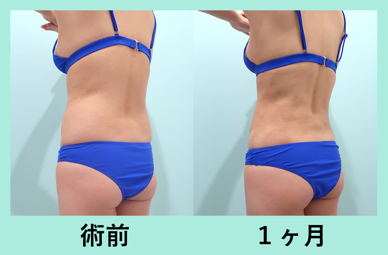 胴体ぐるっと細くする 腹部全体背中腰の脂肪吸引 東京 銀座の美容外科クリニックwom Clinic Ginza