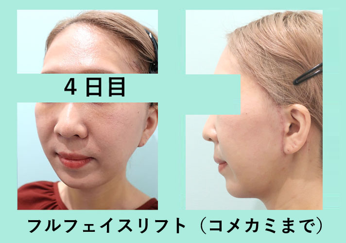 フェイスリフト、切開リフト、こめかみリフト_術後4日目ダウンタイム