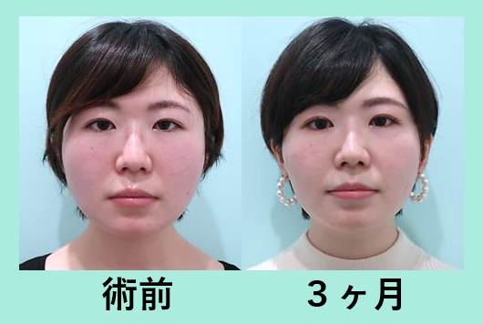 ボトックスとの組み合わせでばっちり小顔に ビフォーアフター３人分ご紹介します 小顔マイクロリポ法 東京 銀座の美容外科クリニックwom Clinic Ginza