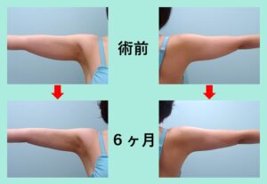 『しっかり細くなる「二の腕肩付け根の脂肪吸引」』の画像