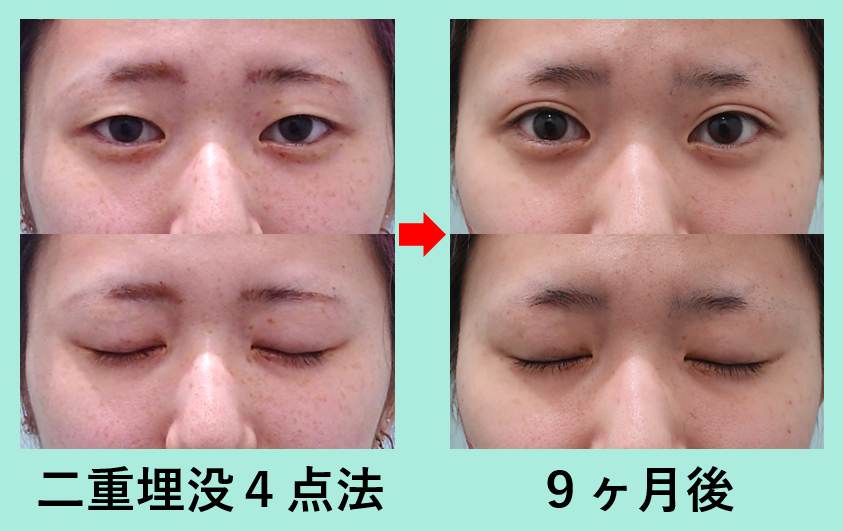 幅広めの平行型を作る 二重埋没４点法 東京 銀座の美容外科クリニックwom Clinic Ginza